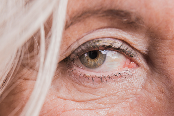 Skin aging first appears around the eyes