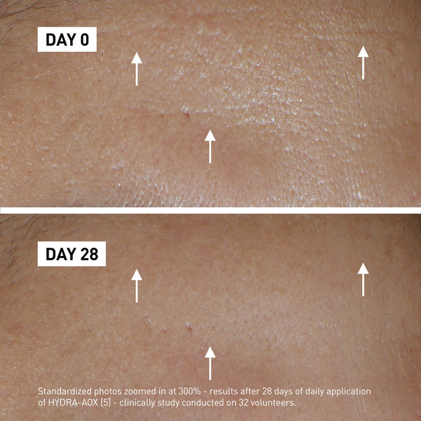 Before and after skin results using Hydra Aox [5]