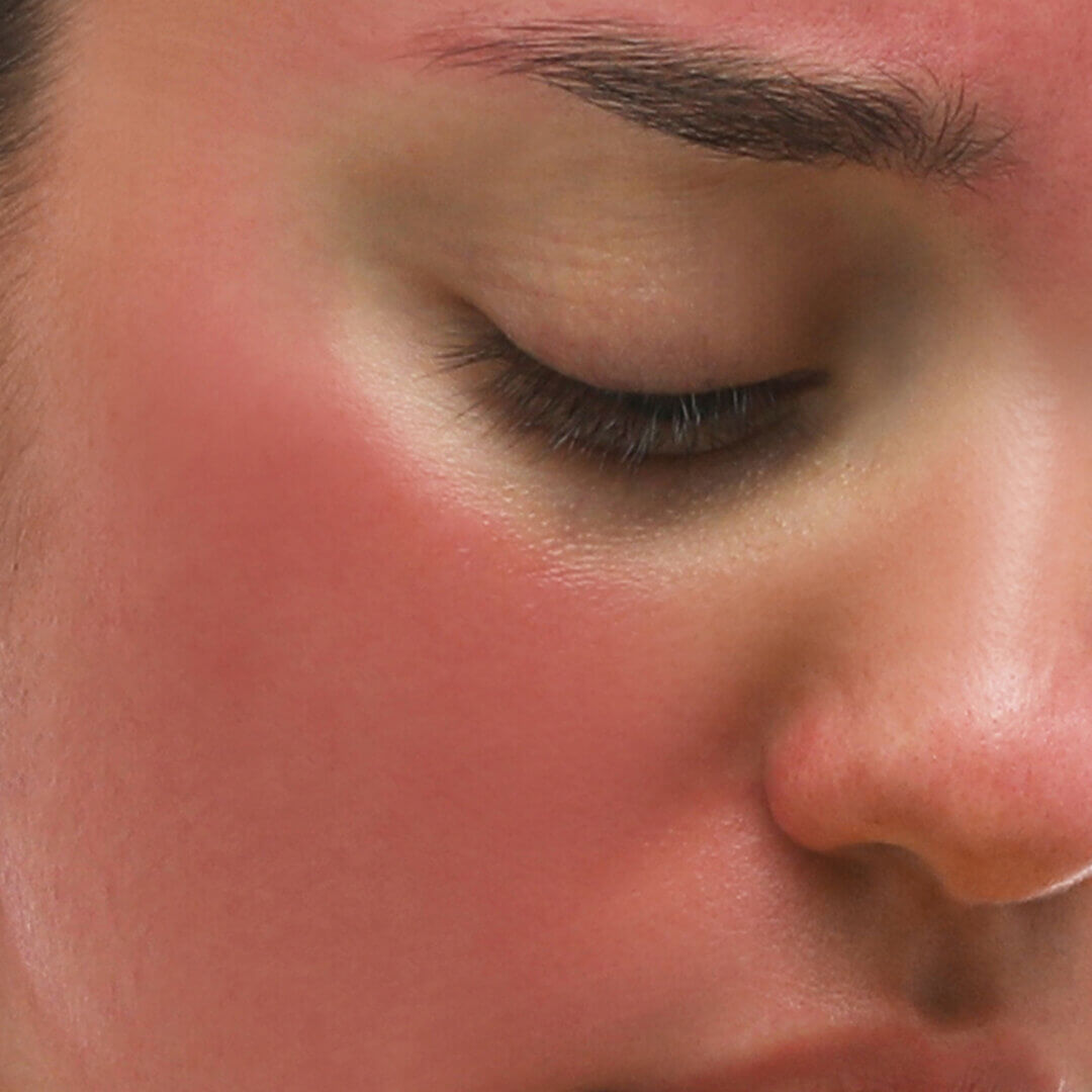 Sunburn is one of the most common reasons for redness in the face.