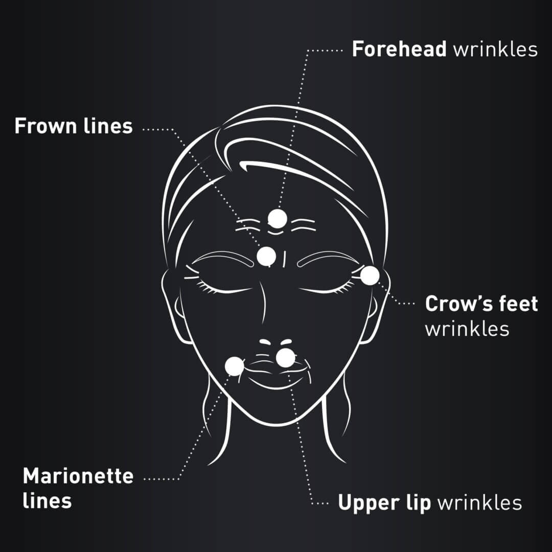 The 5 kinds of expression lines and where they appear on the face.