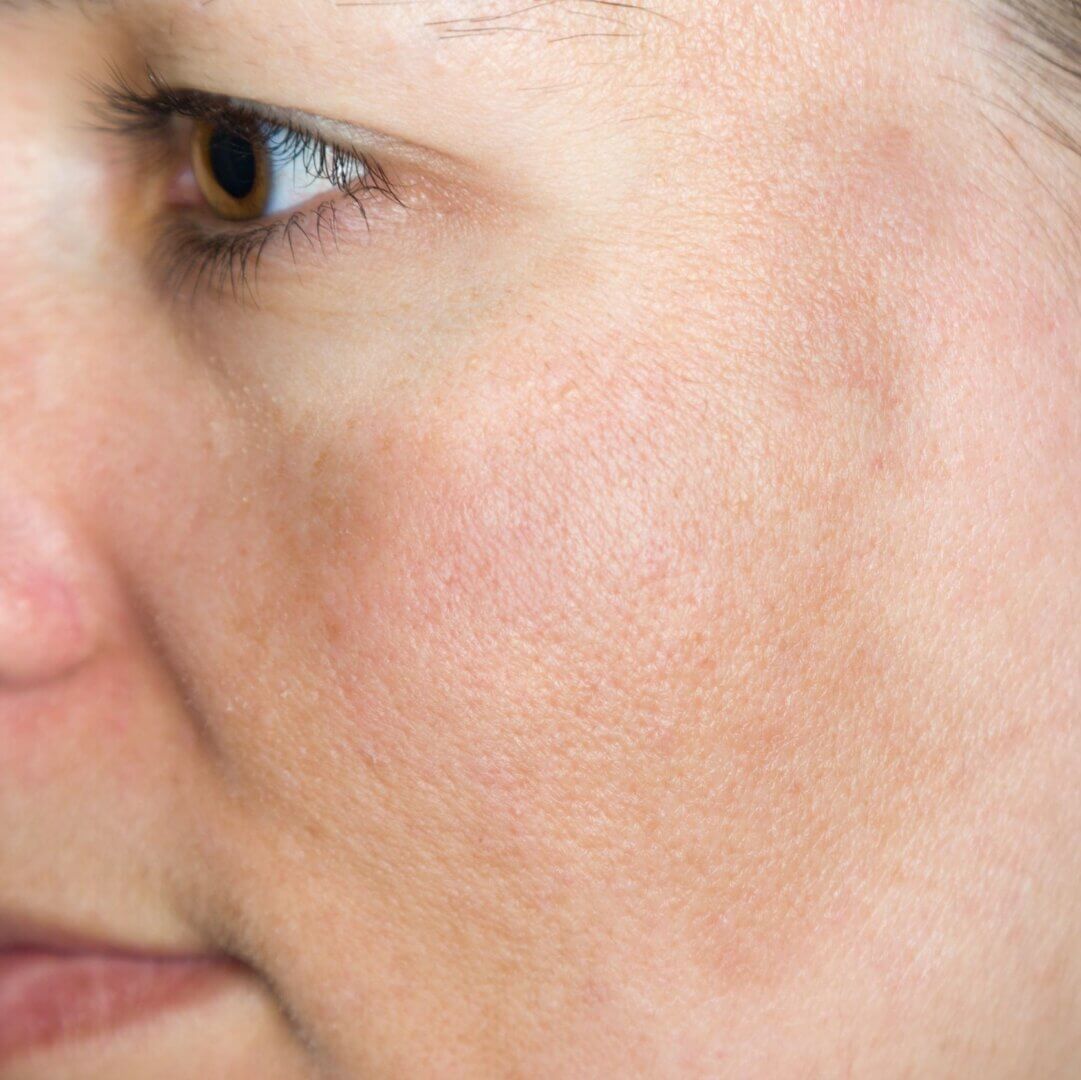 The mask of pregnancy: FILORGA explains everything you need to know about melasma.