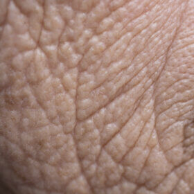 Inflammaging is caused by low-grade inflammation that accelerates aging